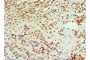 Immunohistochemistry of paraffin-embedded human breast cancer using ABIN7156734 at dilution of 1:100 (IL1RAP 抗体  (AA 21-356))