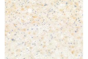 ABIN6261291 and ABIN6279349 at 1/100 staining human astrocytoma by IHC-P.