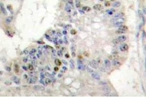 Immunohistochemistry (IHC) analyzes of Histone H1 antibody in paraffin-embedded human colon carcinoma tissue. (Histone H1 抗体)