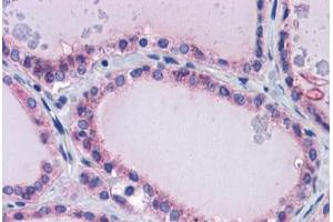 Immunohistochemistry (Formalin-fixed Paraffin-embedded Sections) (IHC (fp)) image for anti-Paired Box 8 (PAX8) (AA 215-264) antibody (ABIN6747006)