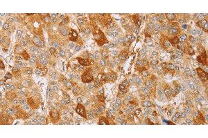 Immunohistochemistry of paraffin-embedded Human liver cancer using CDC46 Polyclonal Antibody at dilution of 1:40 (MCM5 抗体)