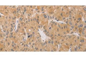 Immunohistochemistry of paraffin-embedded Human liver cancer tissue using ARSK Polyclonal Antibody at dilution 1:30 (Arylsulfatase K 抗体)