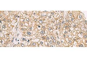 Immunohistochemistry of paraffin-embedded Human liver cancer tissue using CHST2 Polyclonal Antibody at dilution of 1:30(x200) (CHST2 抗体)