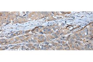 Immunohistochemistry of paraffin-embedded Human breast cancer tissue using GPC5 Polyclonal Antibody at dilution of 1:40(x200) (GPC5 抗体)