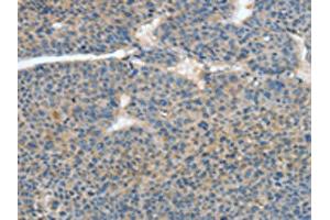 The image on the left is immunohistochemistry of paraffin-embedded Human liver cancer tissue using ABIN7128589(ATP4B Antibody) at dilution 1/40, on the right is treated with fusion protein. (ATP4b 抗体)