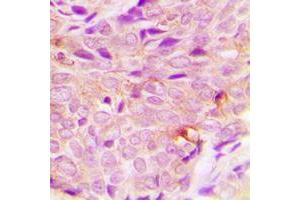 Immunohistochemical analysis of PIGF staining in human breast cancer formalin fixed paraffin embedded tissue section. (PIGF 抗体  (C-Term))