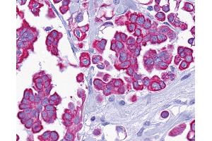 Anti-P2RY14 / GPR105 antibody IHC of human Ovary, Carcinoma.