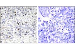 Immunohistochemistry analysis of paraffin-embedded human breast carcinoma tissue, using TEAD2 Antibody. (TEAD2 抗体  (AA 71-120))