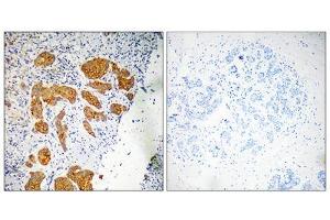 Immunohistochemistry analysis of paraffin-embedded human breast carcinoma tissue, using CKLF4 antibody. (CKLF 抗体  (Internal Region))