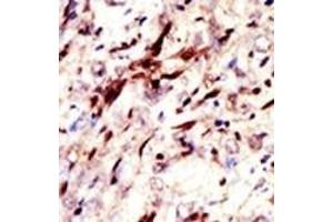 Formalin-fixed and paraffin-embedded human cancer tissue reacted with the primary antibody, which was peroxidase-conjugated to the secondary antibody, followed by AEC staining. (Pan SUMO (SUMO (pan)) 抗体)