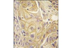 Formalin-fixed and paraffin-embedded human lung carcinoma tissue reacted with EphB2 antibody, which was peroxidase-conjugated to the secondary antibody, followed by DAB staining. (EPH Receptor B2 抗体)