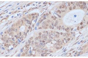 Immunohistochemistry of paraffin-embedded Human colon carcinoma using CDK9 Polyclonal Antibody at dilution of 1:100 (40x lens). (CDK9 抗体)