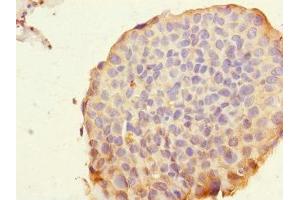 Immunohistochemistry of paraffin-embedded human bladder cancer using ABIN7168447 at dilution of 1:100