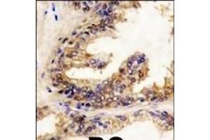 Formalin-fixed and paraffin-embedded human prostata carcinoma reacted with BRAF Antibody (Center) (ABIN392246 and ABIN2841936) , which was peroxidase-conjugated to the secondary antibody, followed by DAB staining. (SNRPE 抗体  (AA 424-453))