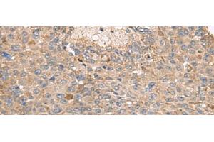 Immunohistochemistry of paraffin-embedded Human liver cancer tissue using ABCA10 Polyclonal Antibody at dilution of 1:50(x200) (ABCA10 抗体)