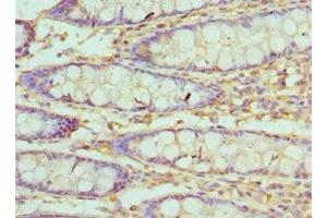 Immunohistochemistry of paraffin-embedded human colon cancer using ABIN7175510 at dilution of 1:100 (Villin 1 抗体  (AA 1-350))