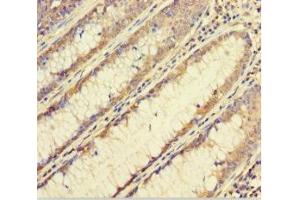 Immunohistochemistry of paraffin-embedded human colon cancer using ABIN7152460 at dilution of 1:100 (FBXL17 抗体  (AA 1-303))