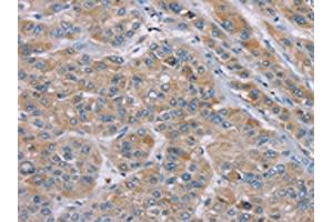 The image on the left is immunohistochemistry of paraffin-embedded Human liver cancer tissue using ABIN7192260(SAMD9 Antibody) at dilution 1/35, on the right is treated with synthetic peptide. (SAMD9 抗体)