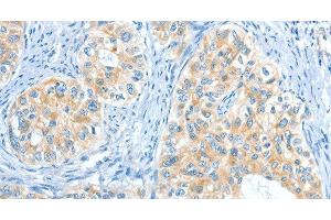 Immunohistochemistry of paraffin-embedded Human cervical cancer tissue using COL4A2 Polyclonal Antibody at dilution 1:70 (COL4a2 抗体)