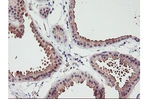 Immunohistochemical staining of paraffin-embedded Human breast tissue using anti-ERCC1 mouse monoclonal antibody. (ERCC1 抗体)