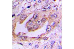 Immunohistochemical analysis of EG5 (pT926) staining in human lung cancer formalin fixed paraffin embedded tissue section.