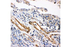 Anti- IKK beta antibody,IHC(P) IHC(P): Human Lung Cancer Tissue (IKBKB 抗体  (AA 398-756))