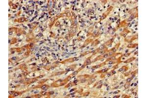 Immunohistochemistry of paraffin-embedded human liver cancer using ABIN7156663 at dilution of 1:100 (IFIT1 抗体  (AA 1-181))
