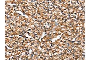 The image on the left is immunohistochemistry of paraffin-embedded Human prostate cancer tissue using ABIN7192449(SLC26A5 Antibody) at dilution 1/20, on the right is treated with synthetic peptide. (SLC26A5 抗体)