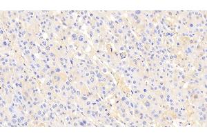 Detection of a2M in Human Liver cancer Tissue using Polyclonal Antibody to Alpha-2-Macroglobulin (a2M) (alpha 2 Macroglobulin 抗体  (AA 616-856))