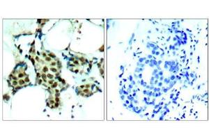 Immunohistochemical analysis of paraffin-embedded human breast carcinoma tissue, using P38 MAPK (phospho- Tyr182) antibody (E011253). (MAPK14 抗体  (pTyr182))