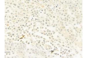 ABIN6261606 and ABIN6279569 at 1/100 staining human non-Hodgkin lymphoma by IHC-P.