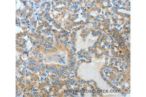 Immunohistochemistry of Human thyroid cancer using BAAT Polyclonal Antibody at dilution of 1:30