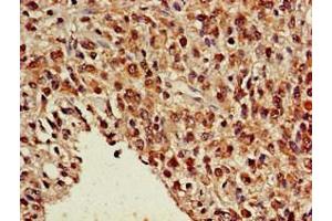 Immunohistochemistry of paraffin-embedded human glioma using ABIN7161911 at dilution of 1:100 (NR5A2 + LRH1 抗体  (AA 182-291))