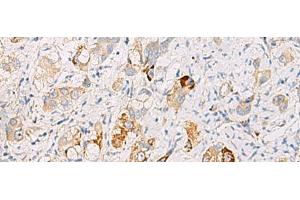 Immunohistochemistry of paraffin-embedded Human liver cancer tissue using DHRS2 Polyclonal Antibody at dilution of 1:50(x200) (DHRS2 抗体)