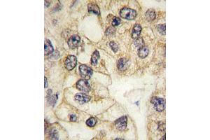 Formalin-fixed and paraffin-embedded human lung carcinoma tissue reacted with CD14 antibody (C-term) (ABIN390261 and ABIN2840719) , which was peroxidase-conjugated to the secondary antibody, followed by DAB staining. (CD14 抗体  (C-Term))