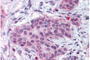 Human Breast Carcinoma (formalin-fixed, paraffin-embedded) stained with MMP13 antibody ABIN301763 at 17 ug/ml followed by biotinylated goat anti-rabbit IgG secondary antibody ABIN481713, alkaline phosphatase-streptavidin and chromogen. (MMP13 抗体  (N-Term))
