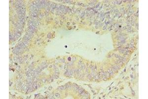 Immunohistochemistry of paraffin-embedded human colon cancer using ABIN7150731 at dilution of 1:100 (CLK2 抗体  (AA 240-499))