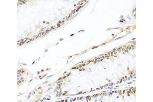 Immunohistochemistry of paraffin-embedded Human colon carcinoma using HIRA Polyclonal Antibody at dilution of 1:100 (40x lens). (HIRA 抗体)