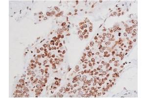 Immunohistochemistry (IHC) image for anti-Mast/stem Cell Growth Factor Receptor (KIT) (pTyr721) antibody (ABIN6256004)