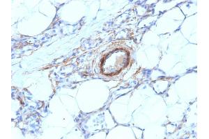 Formalin-fixed, paraffin-embedded human Angiosarcoma stained with SM-MHC Mouse Monoclonal Antibody (MYH11/923). (MYH11 抗体)