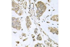 Immunohistochemistry of paraffin-embedded human gastric cancer using SBDS antibody. (SBDS 抗体)