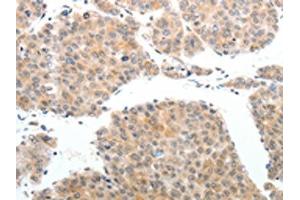 The image on the left is immunohistochemistry of paraffin-embedded Human liver cancer tissue using ABIN7189608(ABL2 Antibody) at dilution 1/25, on the right is treated with synthetic peptide. (ABL2 抗体)