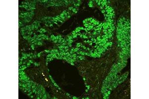 IF analysis of CTBP2 using anti-CTBP2 antibody (ABIN3042768) P-cadherin was detected in paraffin-embedded section of human colon cancer tissues. (CTBP2 抗体  (AA 321-445))