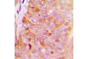 Immunohistochemical analysis of FAM203A staining in human breast cancer formalin fixed paraffin embedded tissue section. (FAM203B 抗体)