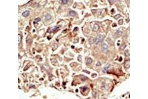 IHC analysis of FFPE human hepatocarcinoma tissue stained with the ALK2 antibody (ACVR1 抗体  (AA 132-162))