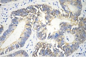 Immunohistochemistry was performed on paraffin-embedded human sigmoid colon carcinoma using catenin beta 1 antibody (ABIN7797927), 1:200). (CTNNB1 抗体)