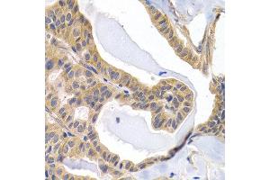 Immunohistochemistry of paraffin-embedded human thyroid cancer using PTGIR antibody at dilution of 1:200 (400x lens). (Prostacyclin Receptor 抗体)