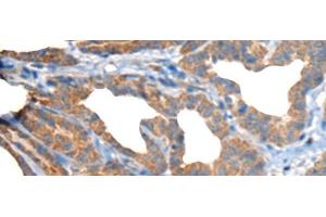 Immunohistochemistry of paraffin-embedded Human thyroid cancer tissue using RTN4IP1 Polyclonal Antibody at dilution of 1:50(x200) (RTN4IP1 抗体)
