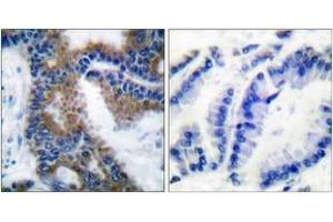 Immunohistochemistry analysis of paraffin-embedded human lung carcinoma, using CrkL (Phospho-Tyr207) Antibody. (CrkL 抗体  (pTyr207))