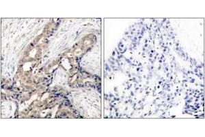 Immunohistochemistry analysis of paraffin-embedded human breast carcinoma, using Abl (Phospho-Tyr393/412) Antibody. (ABL1 抗体  (pTyr393))